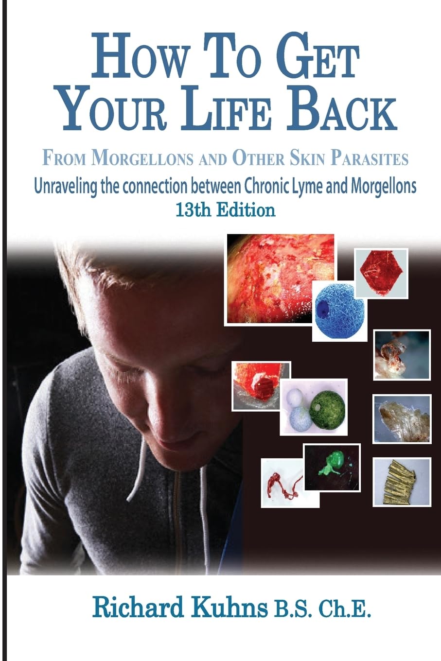 How to Get Your Life Back From Morgellons and Other Skin Par