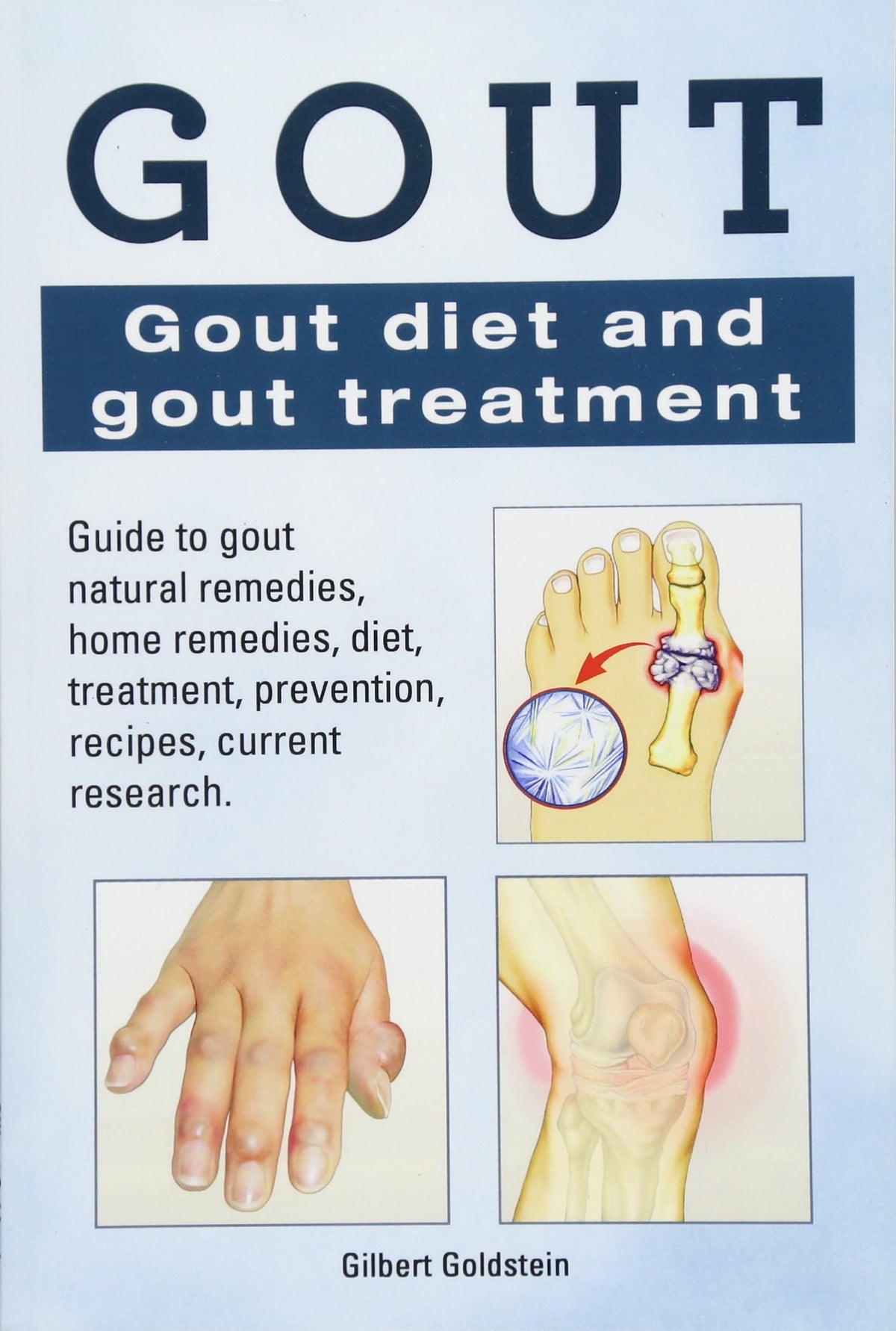 Gout. Gout diet and gout treatment. Guide to gout natural remedies, home remedies, diet, treatment, prevention, recipes, current research.