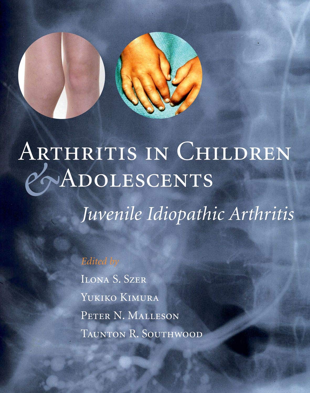 Arthritis in Children and Adolescents: Juvenile Idiopathic A