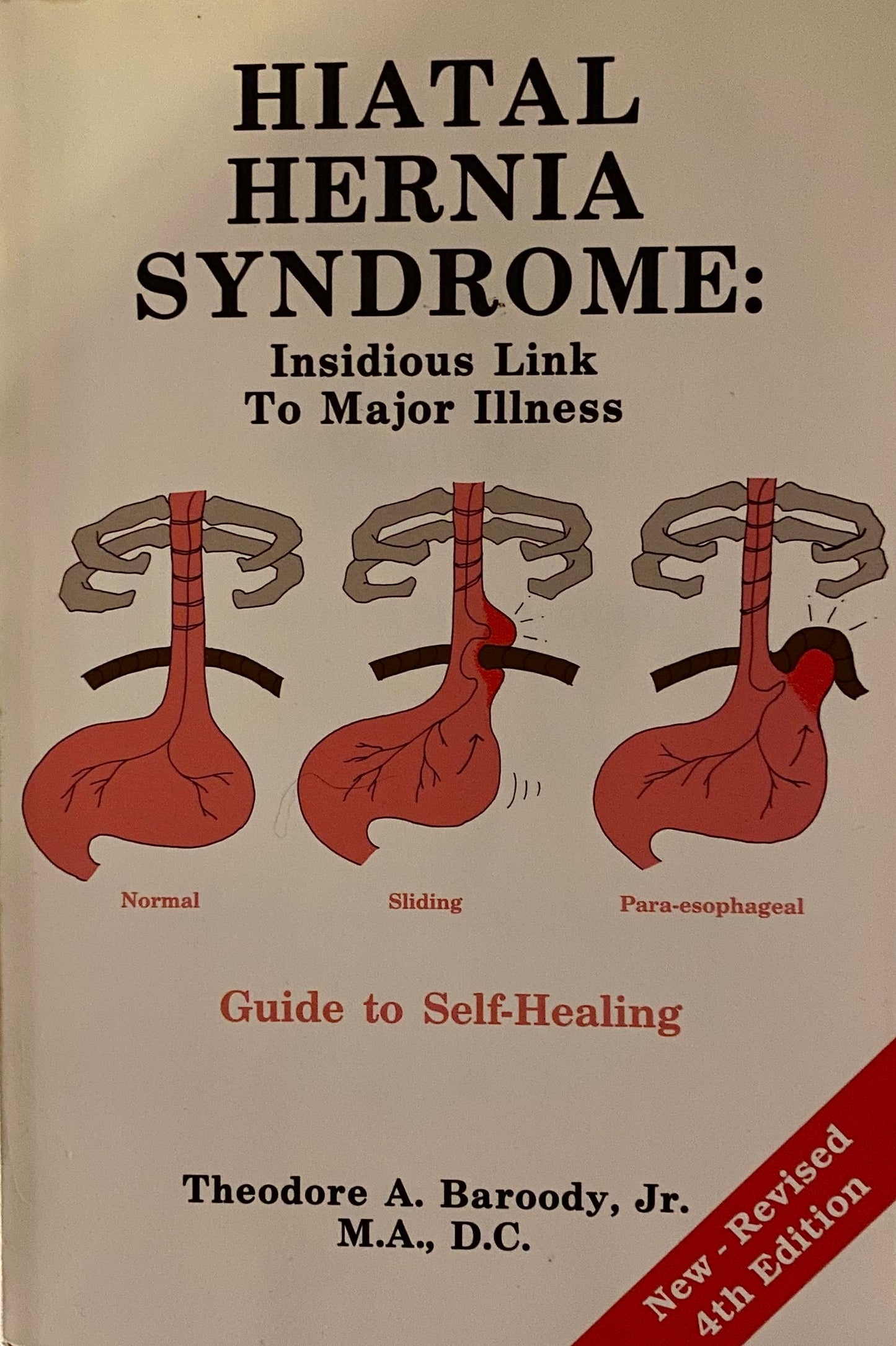 Hiatal Hernia Syndrome: Insidious Link to Major Illness Guide to Healing