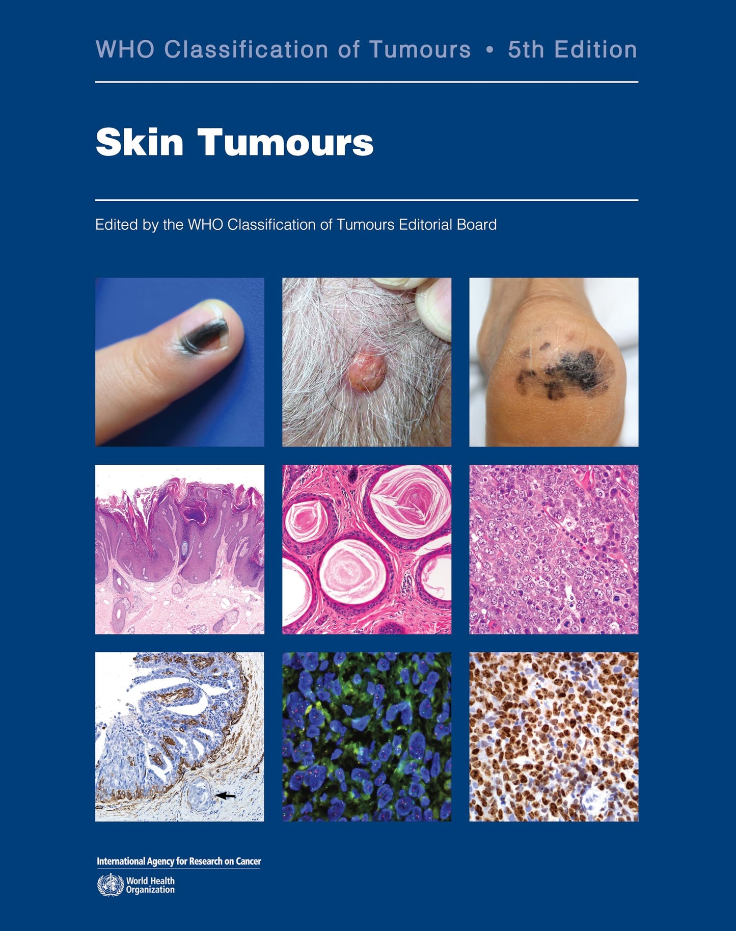 Skin Tumours: WHO Classification of Tumours