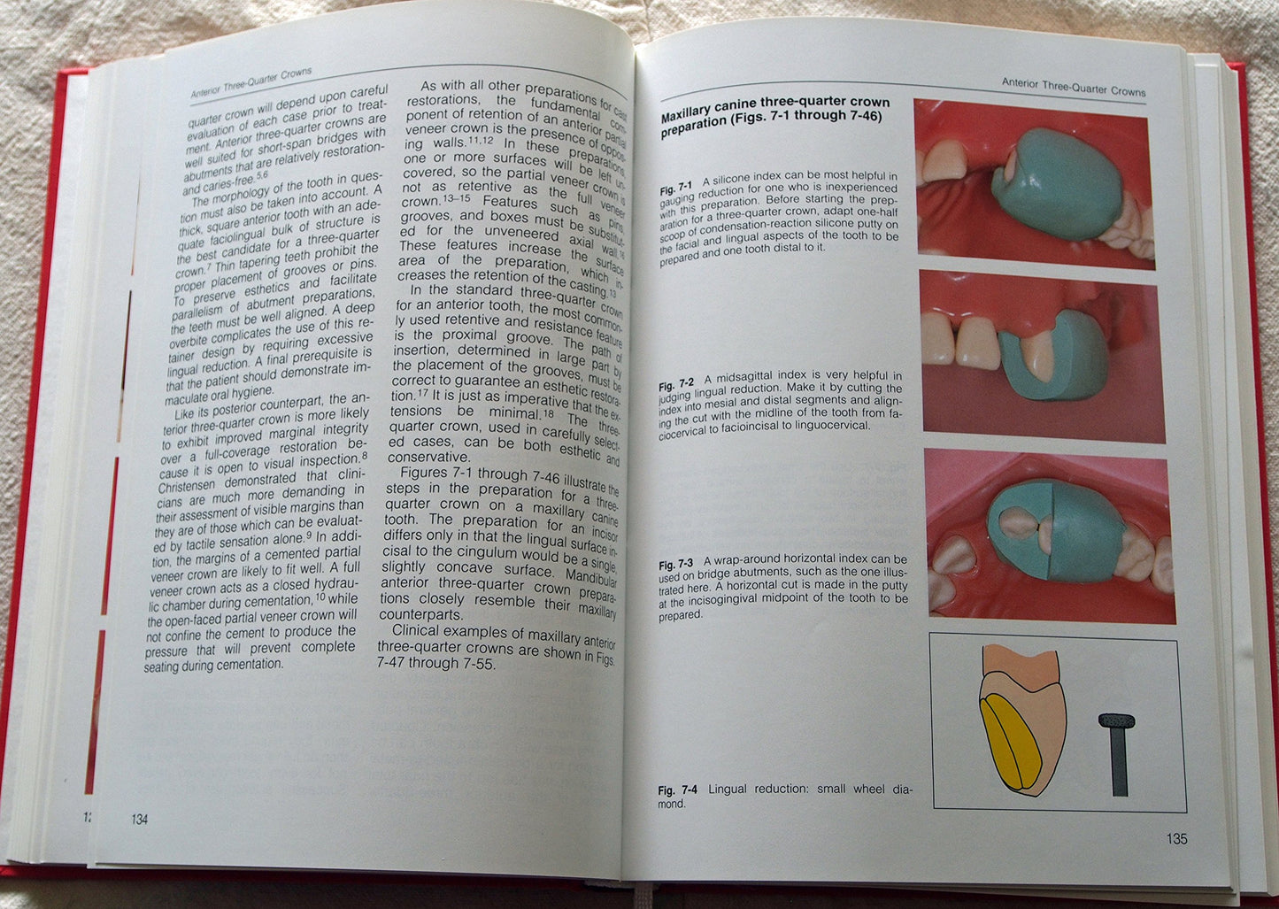 Fundamentals of Tooth Preparations for Cast Metal and Porcelain Restorations