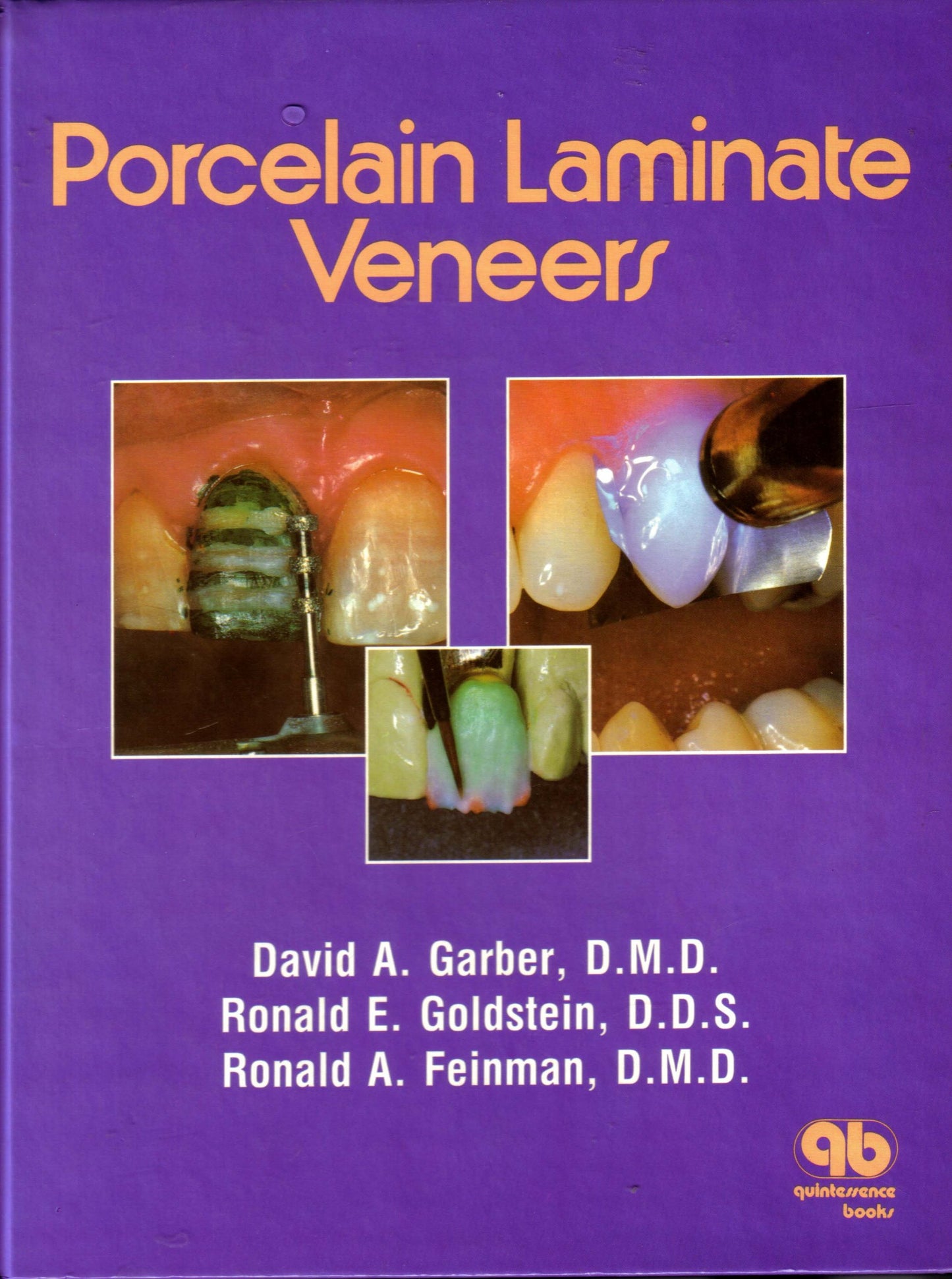 Porcelain Laminate Veneers
