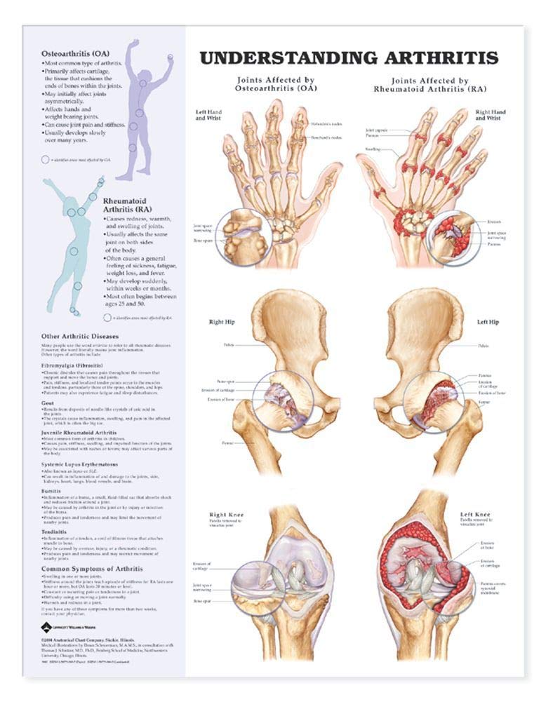 Understanding Arthritis Anatomical Chart