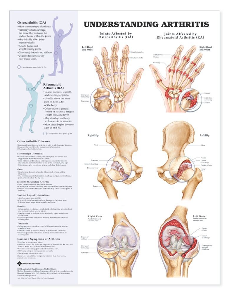 Understanding Arthritis Anatomical Chart
