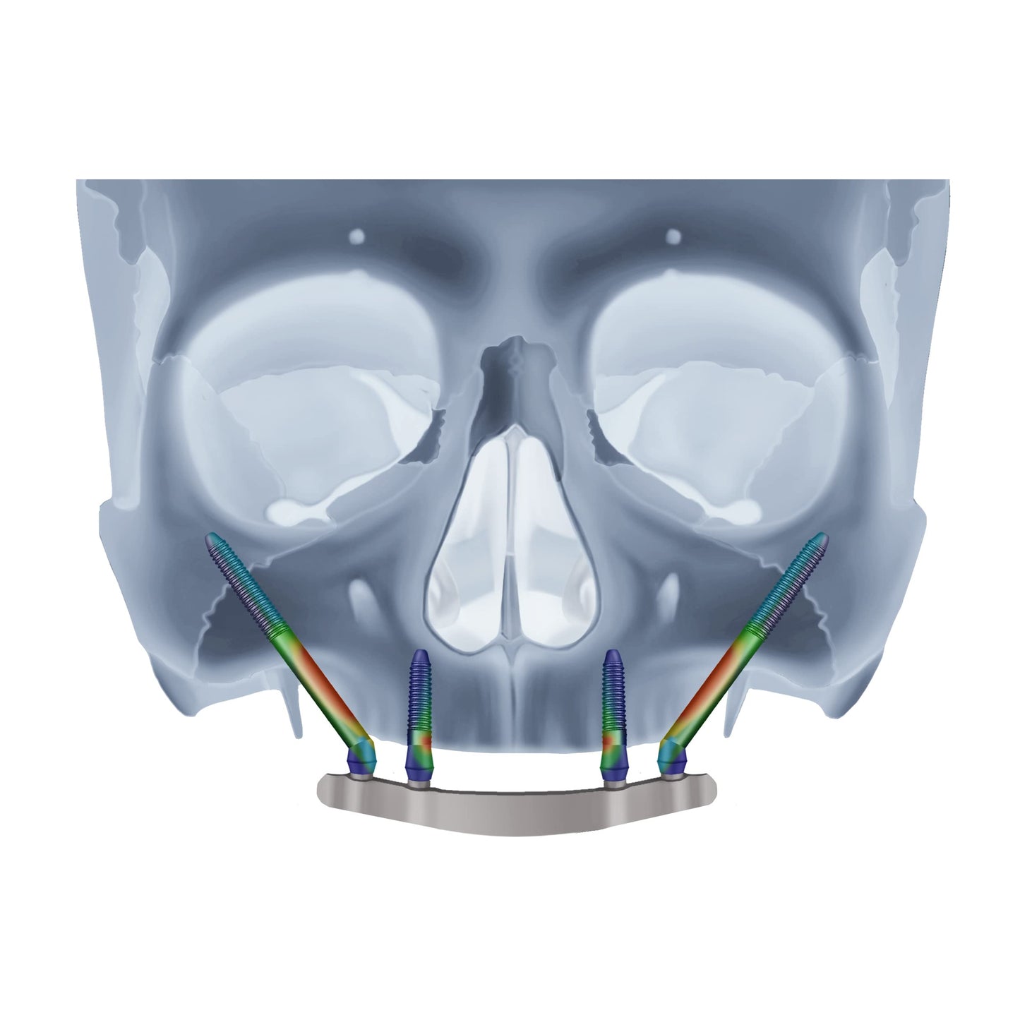 Remote Anchorage Solutions for Severe Maxillary Atrophy: Zygomatic Implants, Pterygoid Implants, Transnasal Implants, Piriform Rim Implants, Nasopalatine Implants, and Trans-Sinus Dental Implants