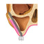 Remote Anchorage Solutions for Severe Maxillary Atrophy: Zygomatic Implants, Pterygoid Implants, Transnasal Implants, Piriform Rim Implants, Nasopalatine Implants, and Trans-Sinus Dental Implants