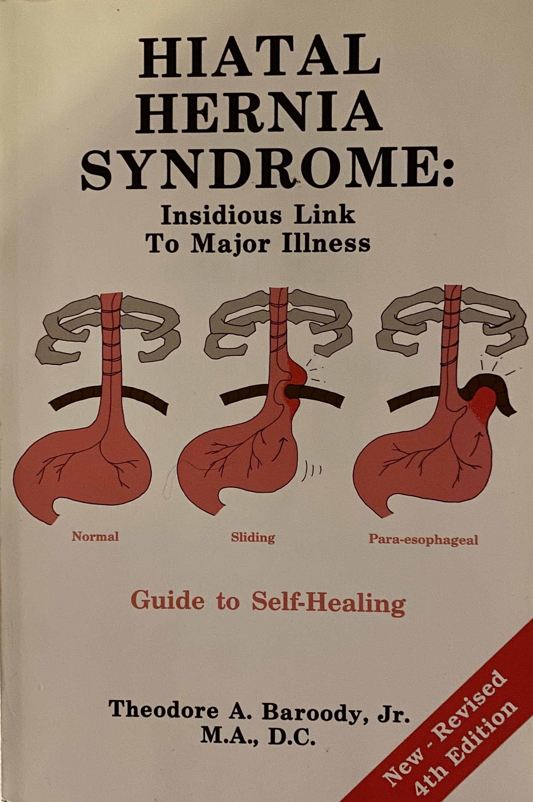 Hiatal Hernia Syndrome: Insidious Link to Major Illness Guide to Healing