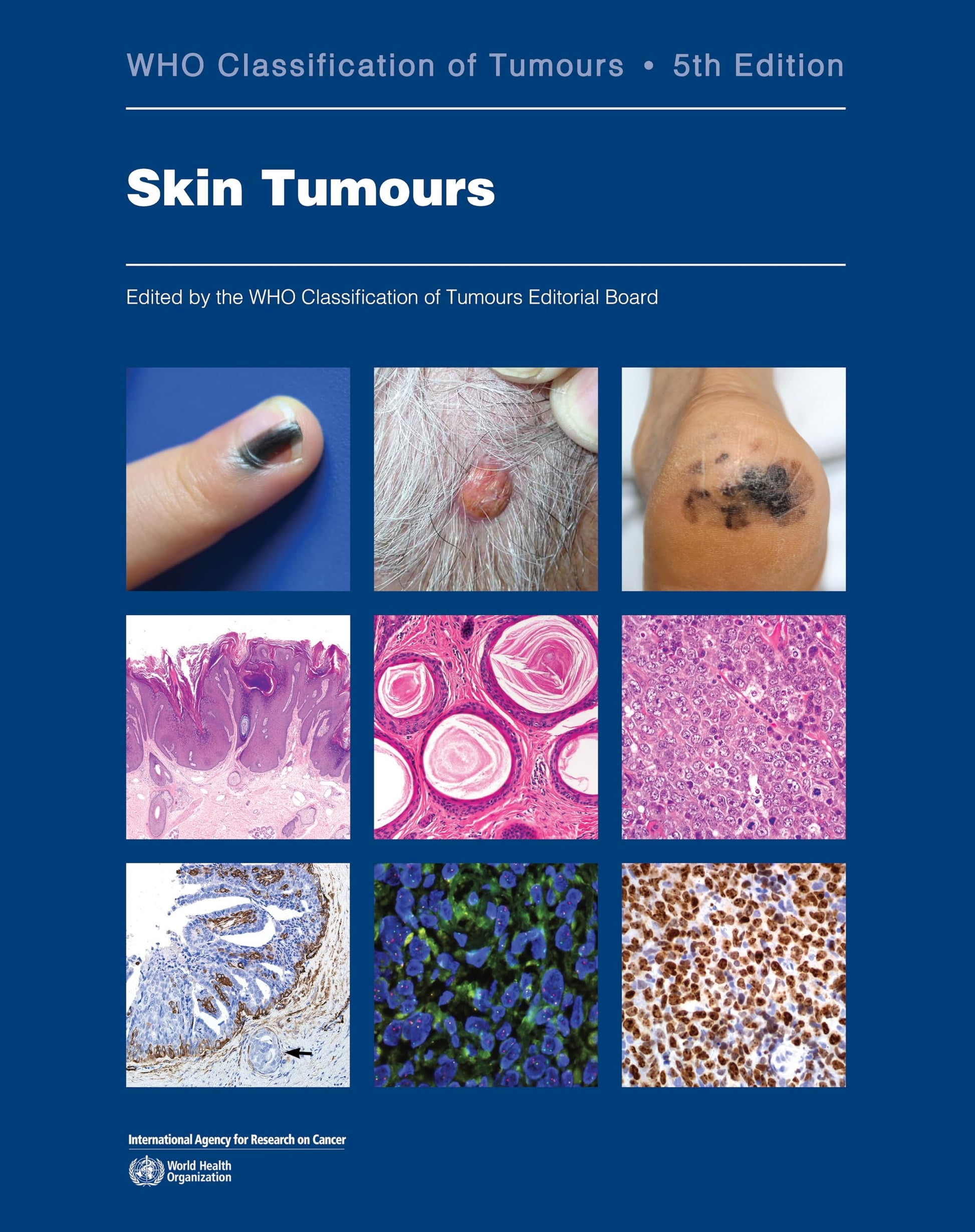 Skin Tumours: WHO Classification of Tumours