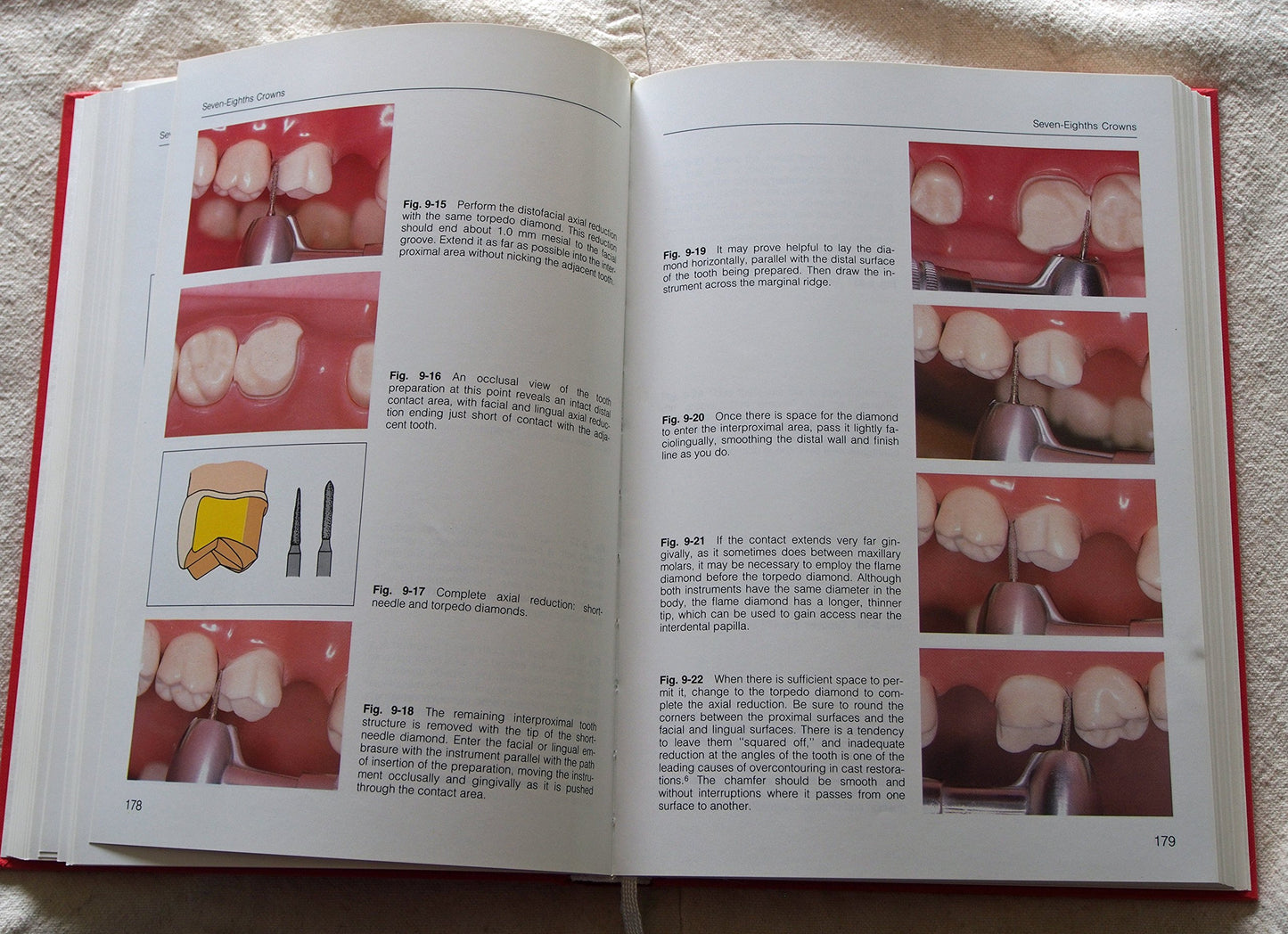 Fundamentals of Tooth Preparations for Cast Metal and Porcelain Restorations