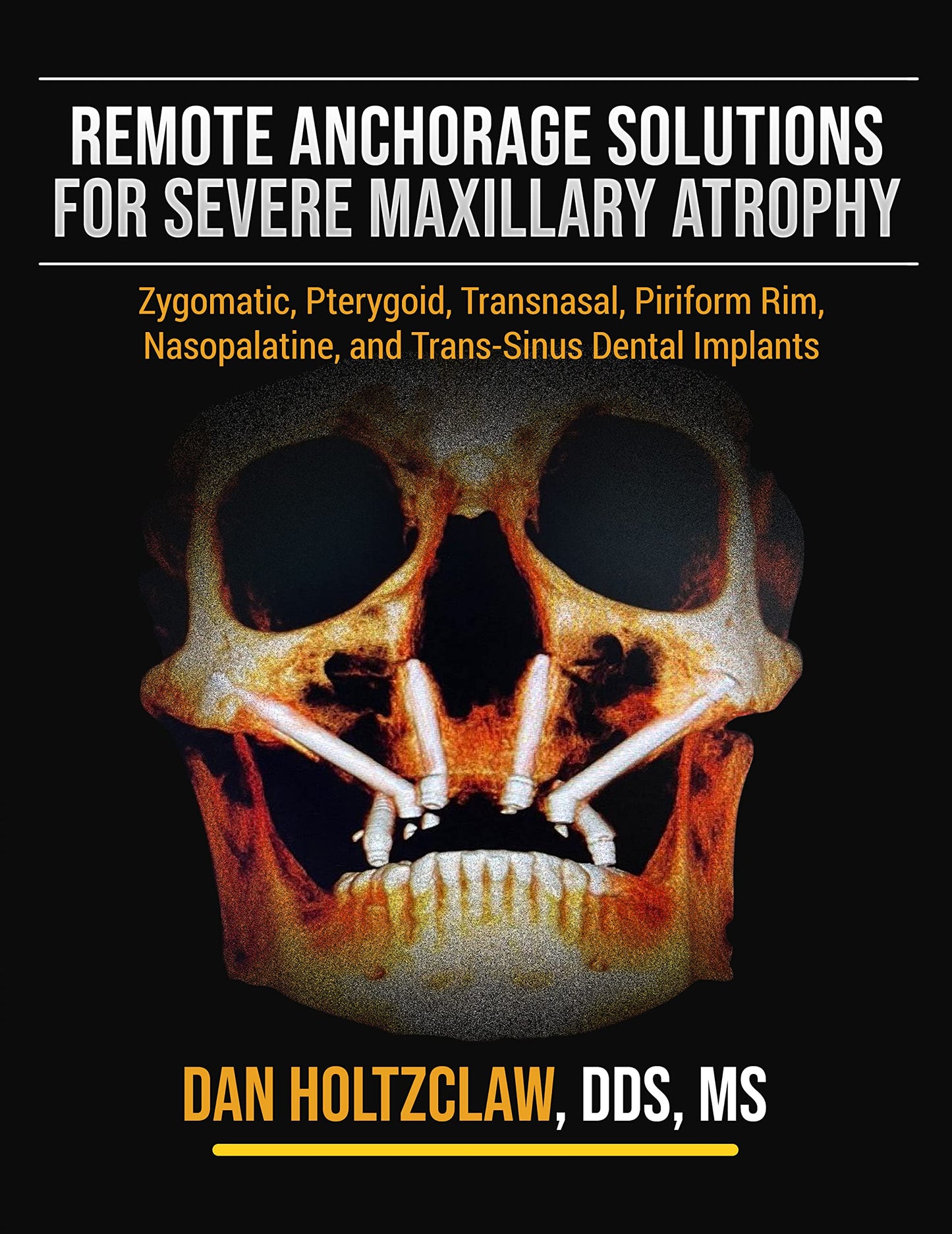 Remote Anchorage Solutions for Severe Maxillary Atrophy: Zygomatic Implants, Pterygoid Implants, Transnasal Implants, Piriform Rim Implants, Nasopalatine Implants, and Trans-Sinus Dental Implants